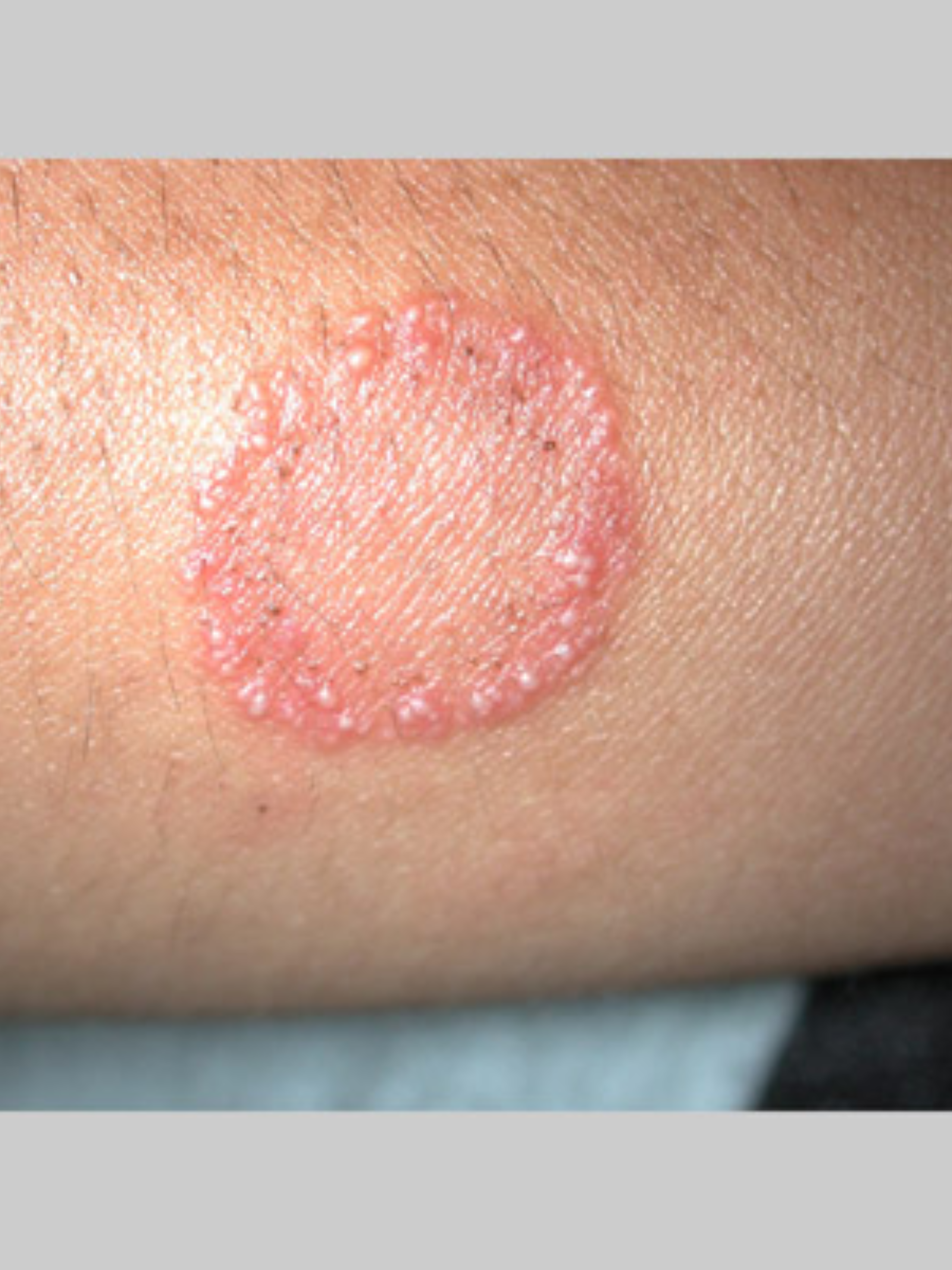 Fungal skin infections treatment at Skin N U Clinics, Kokapet