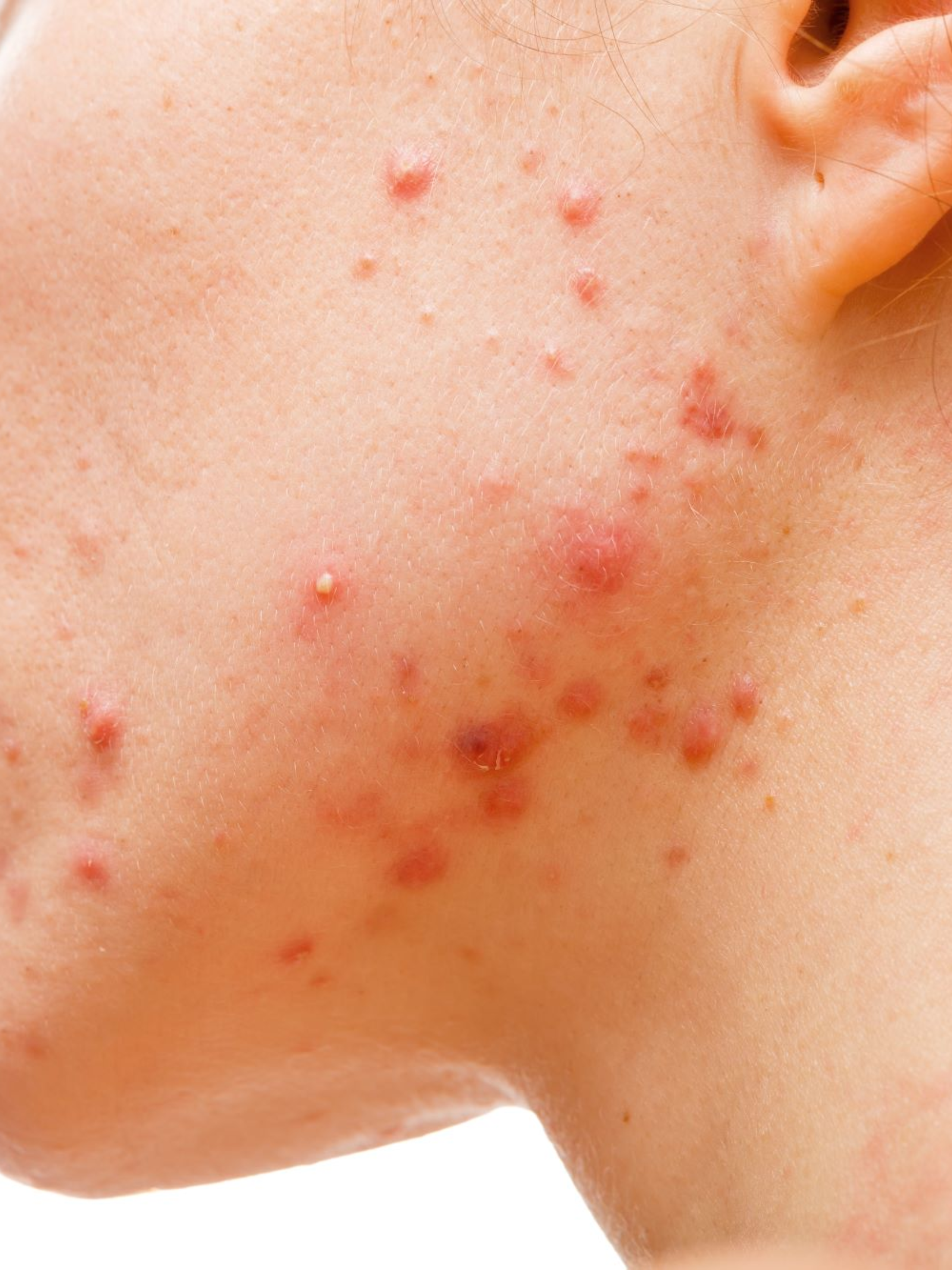 Adult acne vs hormonal acne at Skin N U Clinics, Kokapet